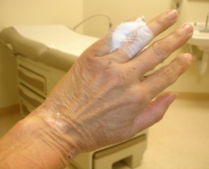 I snuch a pick of my hand when the doctor removed my old cast yesterday