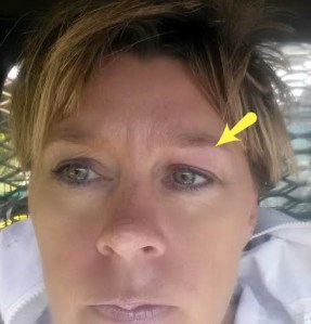 Works like botox... look at the little lines above my right eye... but my stung one is all smooth....